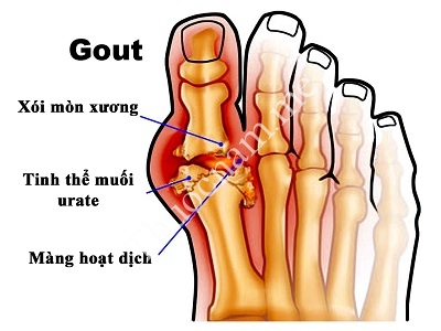 Bệnh gút là gì (gout) bài thuốc nam chữa bệnh gút