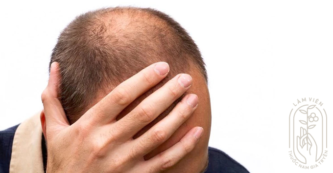 10 bài thuốc chữa bệnh rụng tóc dân gian hiệu quả  Nhà thuốc FPT Long Châu