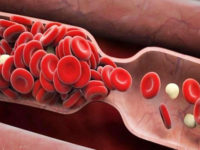 5 dấu hiệu nhận biết cơ thể đang “kêu cứu” với bệnh tắc nghẽn mạch máu