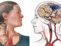 Nguyên nhân, triệu chứng của tai biến mạch máu não & bài thuốc chữa