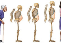 Nguyên nhân – Triệu chứng Bệnh loãng xương & bài thuốc chữa